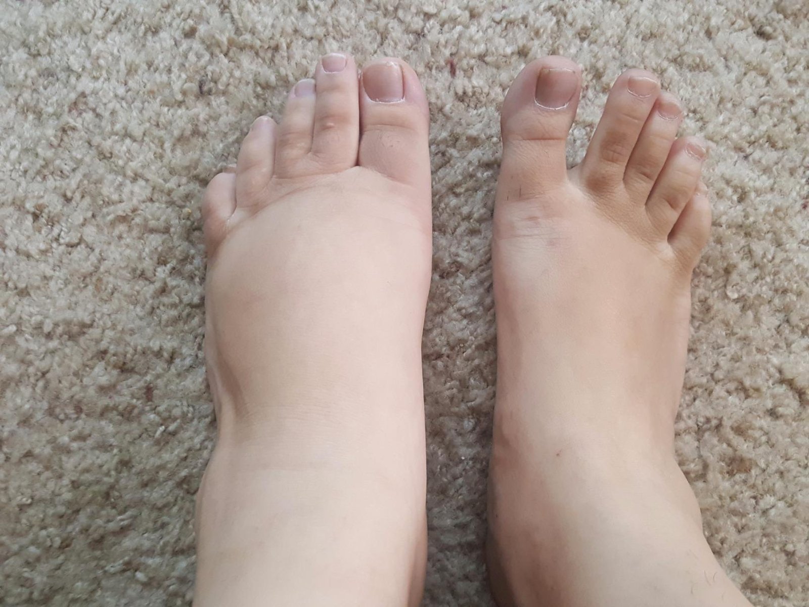 review-1 Customer photo shared in a 1 Body Thyroid Support review showing reduced foot swelling after several weeks of use
